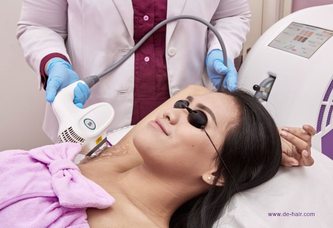 de hair BEST LASER HAIR REMOVAL CLINICS IN JAKARTA